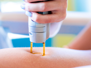 laser hair removal