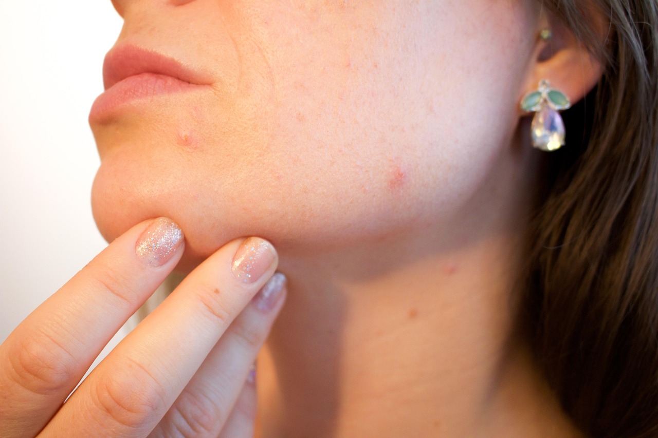 Acne Scar Treatment Sacramento: Your Guide to Smoother Skin with Microneedling