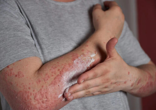 Itchy Skin Rash Telehealth